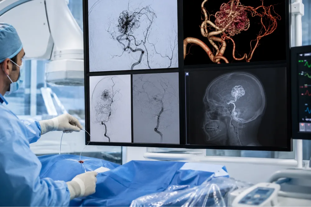 Malformaciones arteriovenosas cerebrales en Querétaro y Guanajuato: diagnóstico y tratamiento